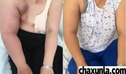 手术后出现水肿怎么办