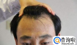 天生发际线高还有救吗？