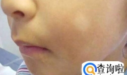 怎么判断小孩需要打虫