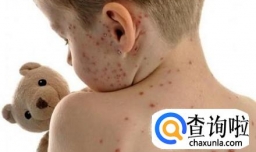 孩子出水痘家长怎么办