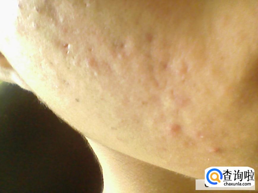 怎样消除痘印美白