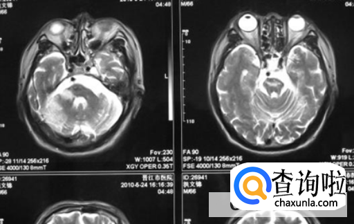 脑梗塞有哪些前兆