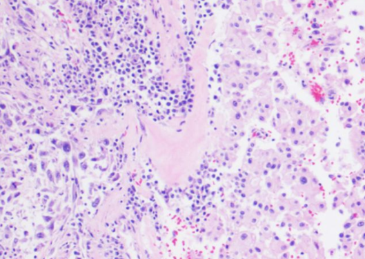 什么是嫌色细胞癌