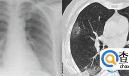 奥密克戎导致白肺的几率不高吗