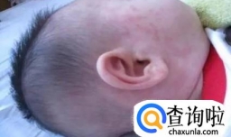 正确处理幼儿急疹