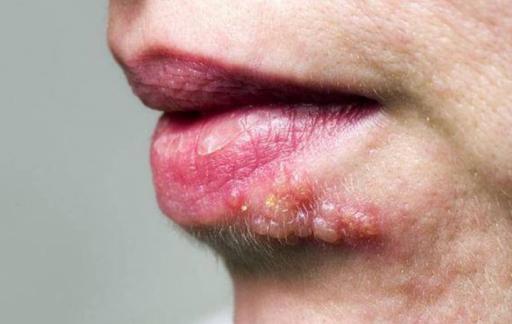 嘴上疱疹有脓能挤么