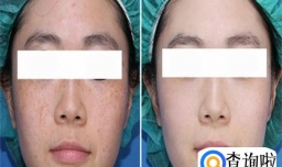 脸上雀斑怎么根除
