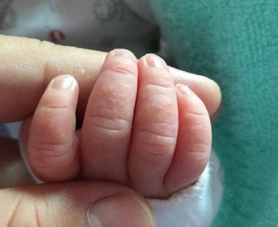 真菌感染怎么办