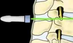 冷冻饥饿神经为什么有助于减肥 原理是什么
