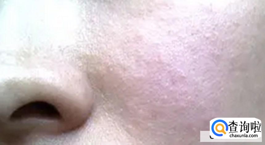 怎么做好皮炎的预防