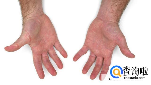 如何有效地对痛风进行护理