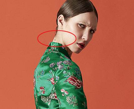 脖子上有痣代表什么