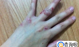 什么是传染性湿疹皮炎