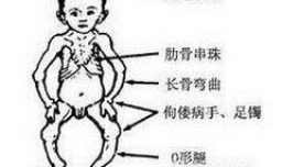 佝偻病会影响身高吗？