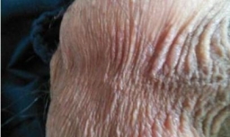 阴囊湿疹怎么办