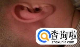 孩子淋巴结肿大怎么办