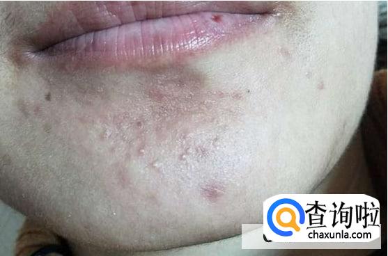 下巴长小痘痘是什么原因