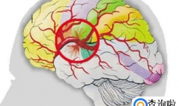 脑溢血是什么意思