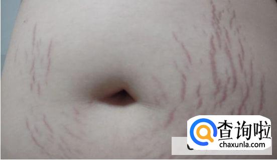 女孩子没怀过孕会有妊娠线吗