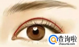 双眼皮的类型有哪些
