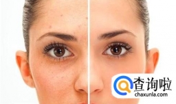 痘印痘坑如何修复