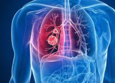 晚期肺癌的如何控制病情