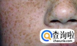 黑雀子怎么形成的/怎样去除黑雀(悄)子好方法