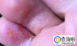 脚上起小水泡是脚气吗