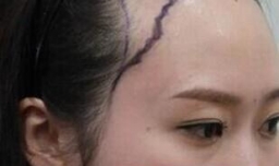 刚纹的发际线怎样去掉