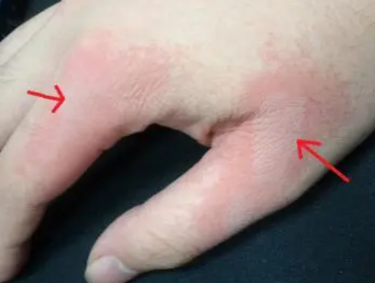 烫伤之后要注意点啥