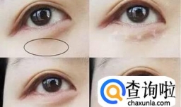 为什么会有脂肪粒，什么原因。