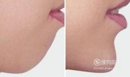 改善下巴后缩的方法