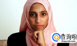 晒斑和黄褐斑的区别