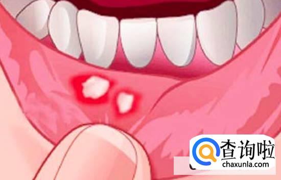 口腔溃疡怎么处理
