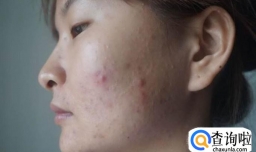 怎样去闭合性粉刺