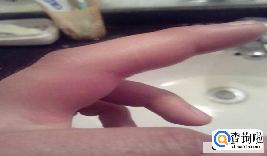 被蜂子蛰了怎么办