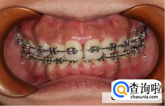 天天都能做的口腔保健方法细节是关键