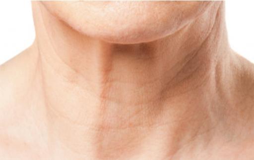 怎么去除法令纹