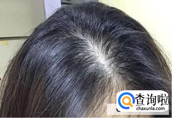 勤洗头发长得快还是不洗头发长得快