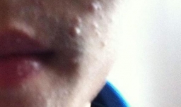 有哪些常见的皮肤病