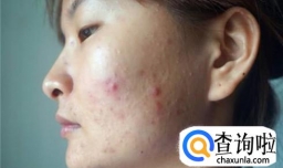 闭合性粉刺如何治粉刺怎么去除小妙招用什么有效