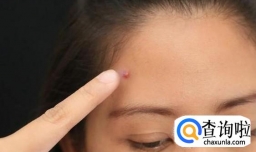 快速去痘痘小窍门