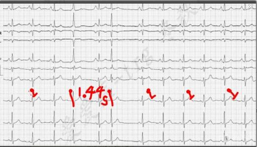 早搏是什么意思
