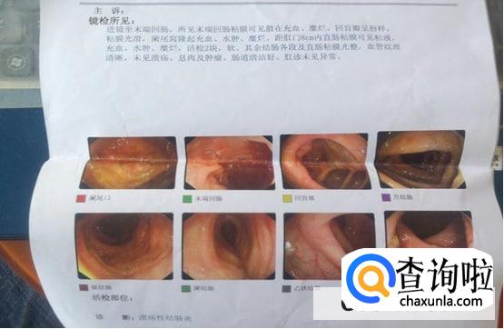 慢性结肠炎能吃菠菜吗