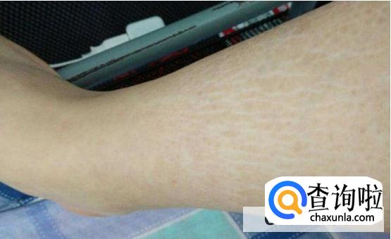 女孩子没怀过孕会有妊娠线吗