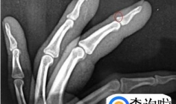 手指骨折怎么做康复训练