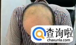 发际线高的人更容易秃头吗？为什么？