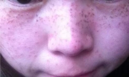 药水点斑的危害/点斑水治疗雀斑害处是什么