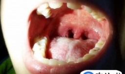 如何应对儿童疱疹性咽颊炎