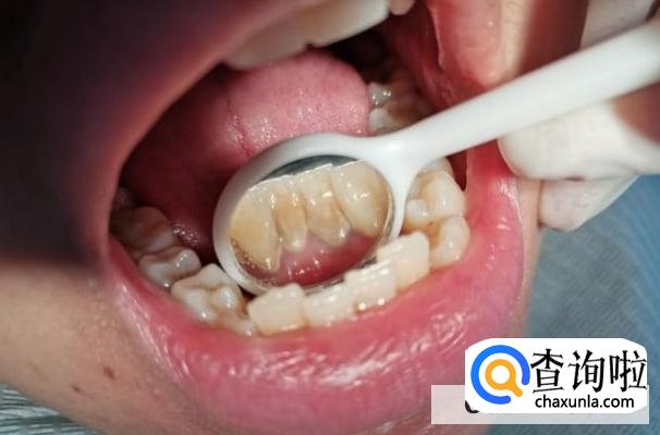 先洗牙还是先补牙